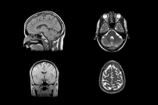 MRI scans of the human brain